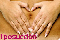 pic_liposuccion